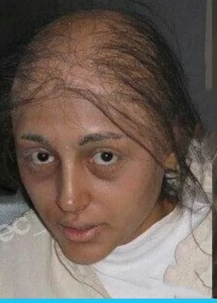 سرطان گلشیفته فراهانی با یک عکس در فضای مجازی مثل بمب ترکسید و عکسی که از او با سر و وضع ناراحت کننده پخش شده هوادارانش را ناراحت کرد.

سرطان گلشیفته فراهانی با یک عکس در فضای مجازی مثل بمب ترکسید و عکسی که از او با سر و وضع ناراحت کننده پخش شده هوادارانش را ناراحت کرد.

اما واقعیت ماجرا چیز دیگری است.

تدریس فیزیک کنکور با استاد کامران مولف خیلی سبز +نمونه تدریس رایگان
تبلیغ
تدریس فیزیک کنکور با استاد کامران مولف خیلی سبز +نمونه تدریس رایگان
مشاهده تدریس
yn-ad
این عکس مربوط به سالهای بسیار قبل است که گلشیفته در ایران زندگی می کرد.

گریم دردسرساز گلشیفته فراهانی
گلشیفته فراهانی برای اجرای یک از نقش هایش در نقش یک دختر سرطانی به این شکل گریم شده بود.

سرطان گلشیفته فراهانی صحت ندارد و این عکس قدیمی با این گریم شایعه سرطان او را درست کرد.

گلشیفته فراهانی در صحت و سلامت به سر می برد و این اخبار با پخش شدن در فضای مجازی مثل یک بمب خبری ترکید .