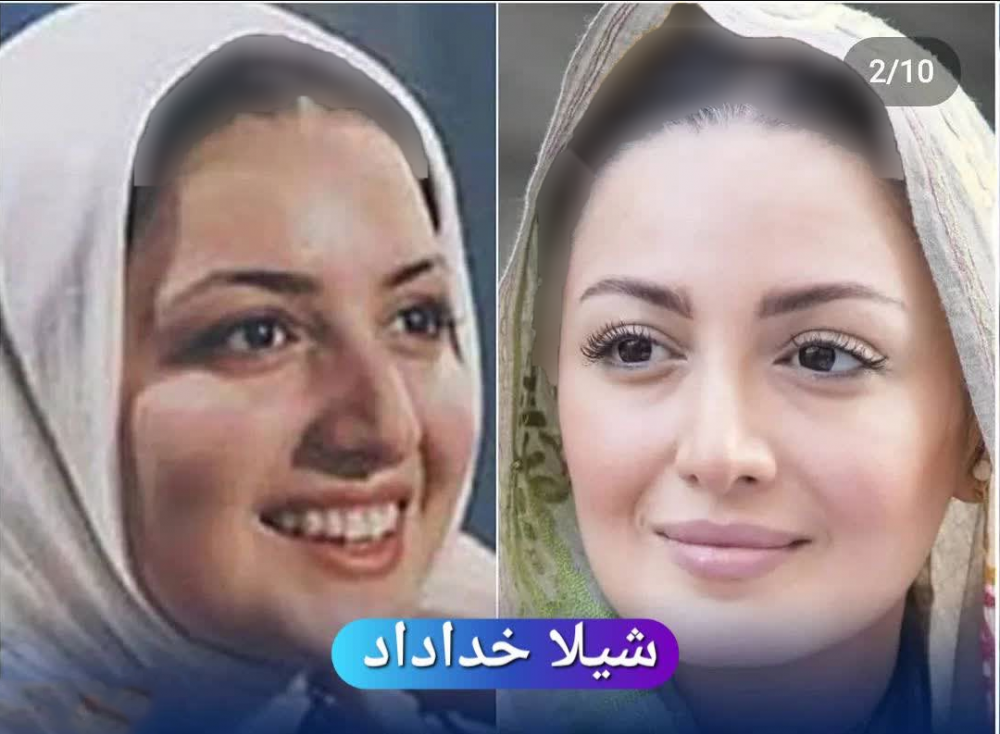 عکس بازیگران زن ایرانی قبل و بعد از عمل زیبایی
