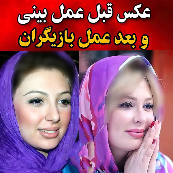 عکس قبل عمل بینی بازیگران