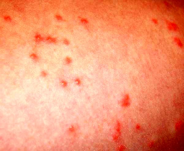 علت لکه قرمز پوست