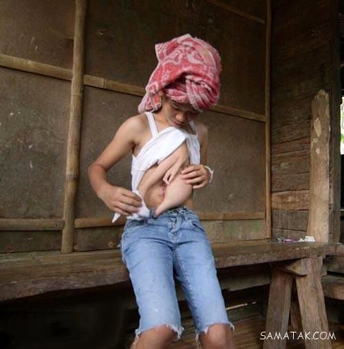 سینه های دختر 14 ساله به شکل عجیب + تصاویر