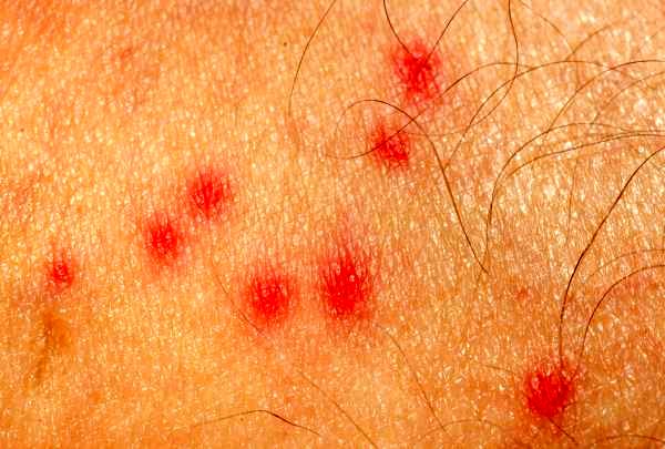 دانه قرمز بدون خارش